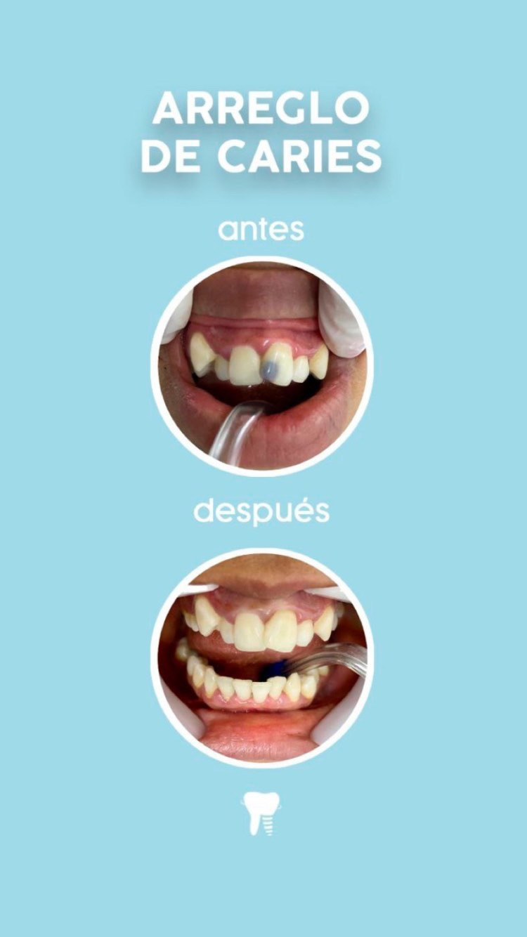 Tratamiento dental en Consultorios Odontologicos San Miguel